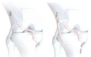 DR PIERRE NONET – Ligamentoplastie de type DT4 – DT4 associé à une plastie antérolatérale DR PIERRE NONET - Ligamentoplastie de type DT4 - DT4 associé à une plastie antérolatérale
